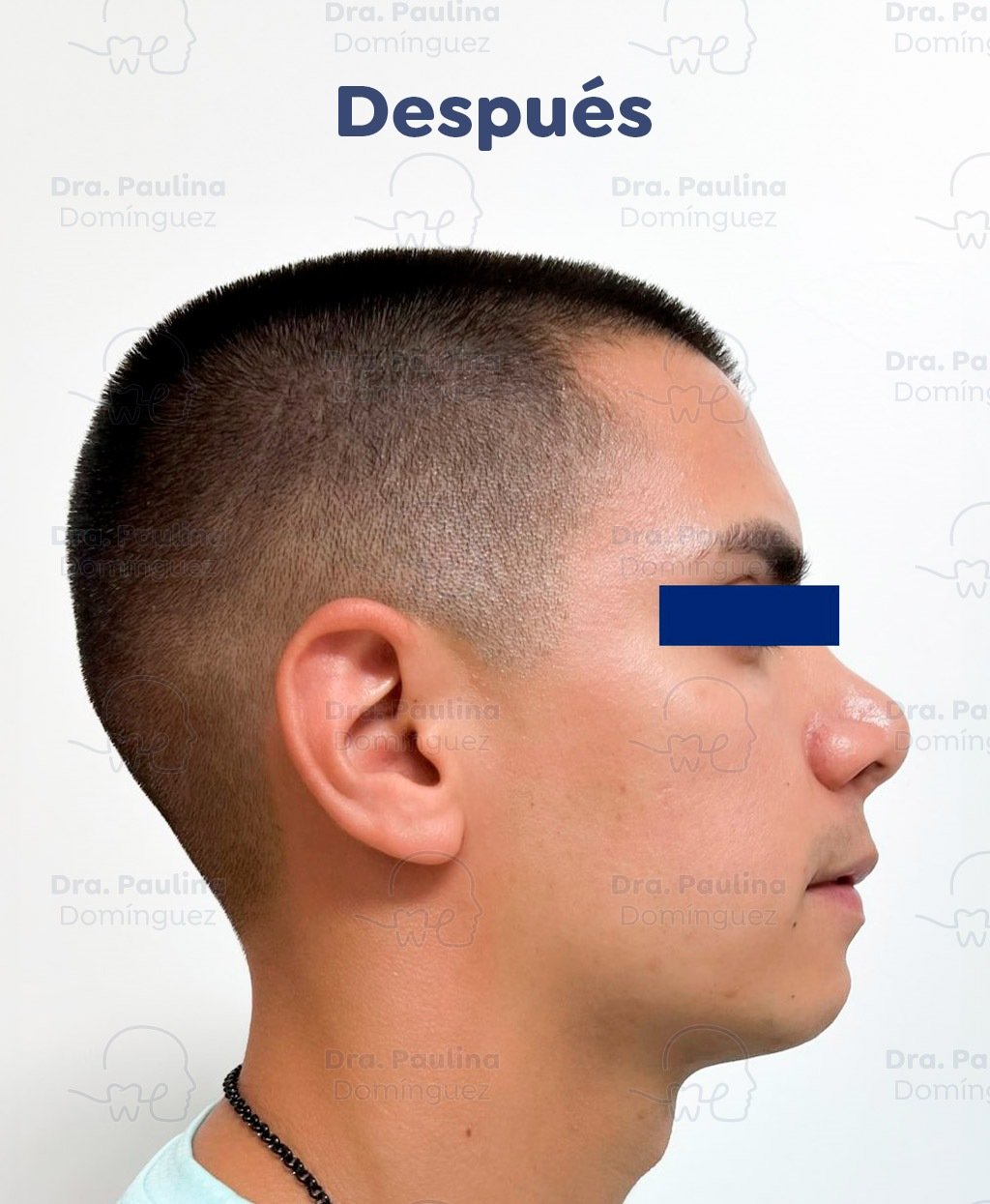 Caso-1.-Mentoplastia-01-(Despues)