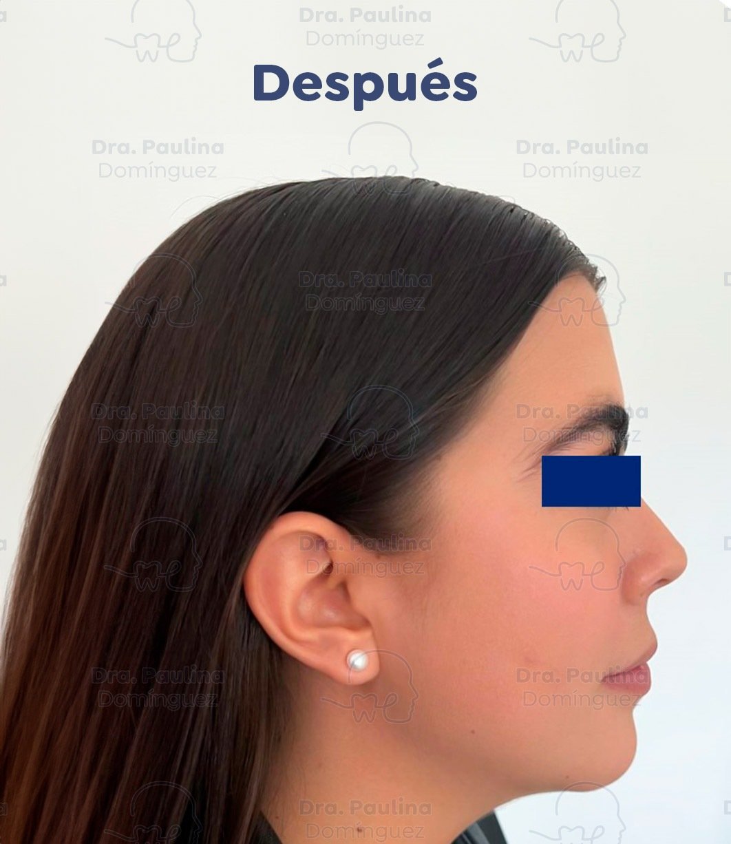 Caso-2.Mentoplastia-01-(Despues)