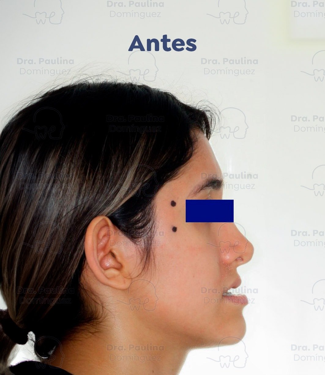 Caso-3.-Ortognatica-02-(Antes)